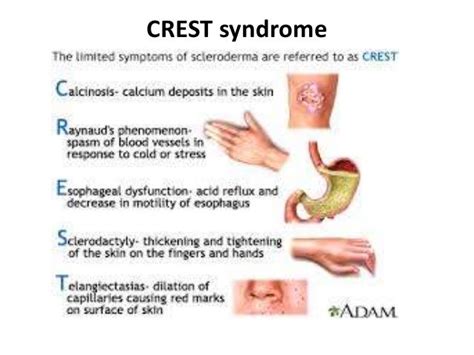 Progresive systemic sclerosis