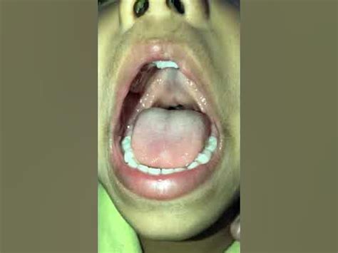 submucous cleft - YouTube