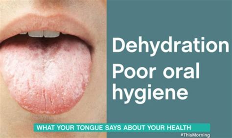 Dehydration Symptoms Tongue