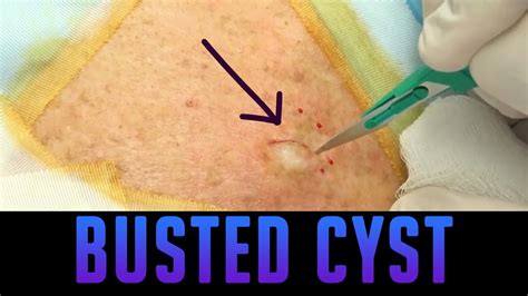 Excellent Epidermoid Cyst Excision - YouTube