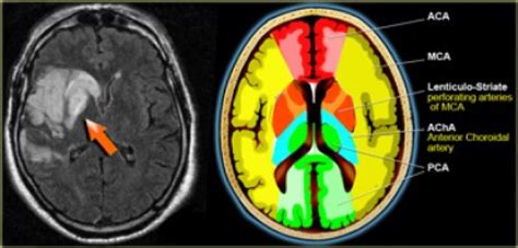 Middle cerebral artery (anatomy) - Radiology Notes