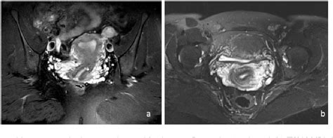 Figure 2 from Evaluation of sacroiliac joint MRI for pelvic venous ...