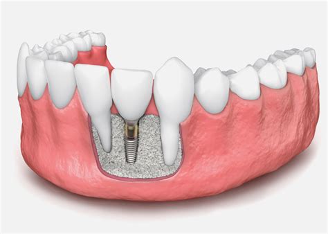 Bone Grafting: Why It’s Needed and How It Works - My Dentist Toluca Lake