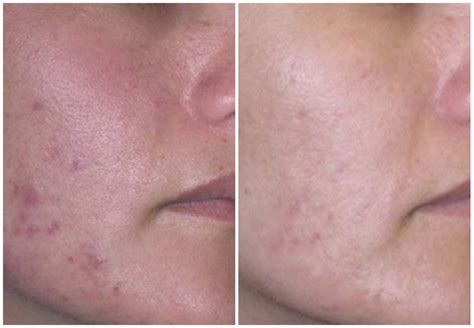 BBL Laser Before and After | Altaire Clinic