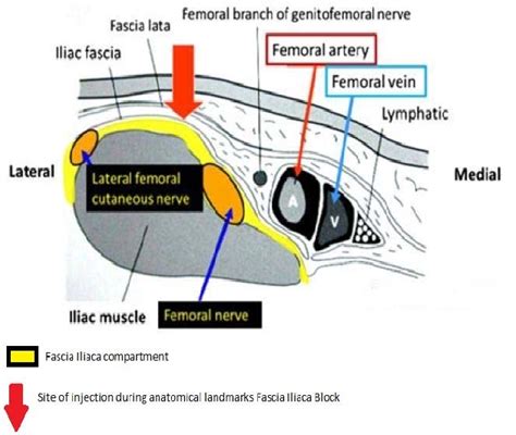 Figure 2 from Fascia Iliaca Block ( FIB ) in elderly patients outside the operating room for ...