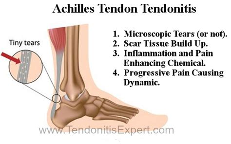 Torn Achilles Tendon, Heal Fast or Heal Slow After Achilles Tendon Surgery