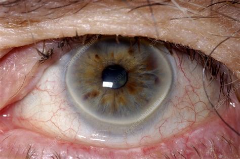 Arcus senilis iris disorder - Stock Image - M155/0555 - Science Photo Library