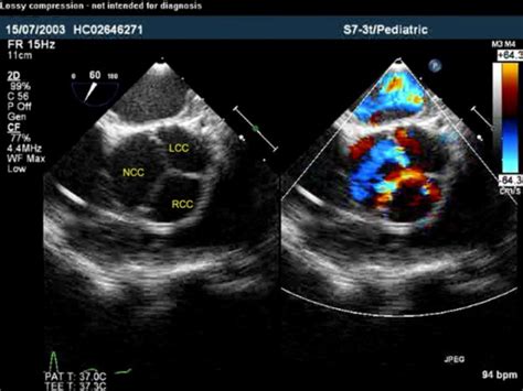 Parasternal Short Axis View Aortic Valve