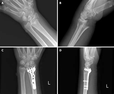 Non displaced distal radius fracture - famebery