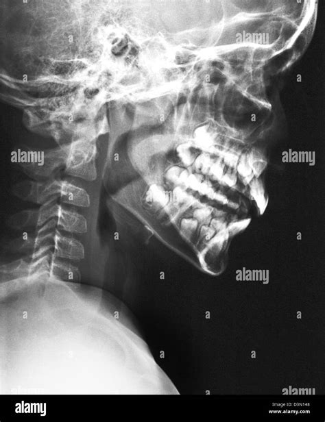 lateral skull x-ray of a child showing the development of the adult teeth Stock Photo - Alamy