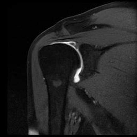 Biceps brachii tendon rupture | Radiology Reference Article | Radiopaedia.org