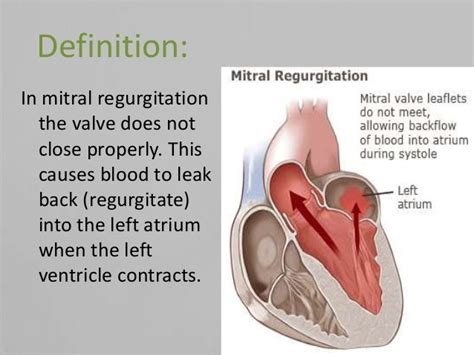 Mitral regurgitation