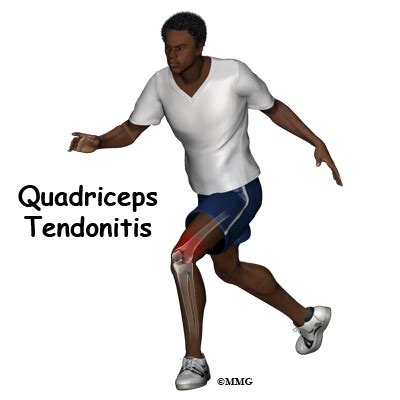 Quadriceps Tendonitis | eOrthopod.com