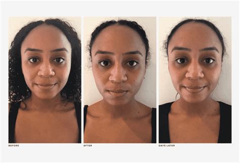 I’m a Black Woman Who Tried My First Laser Treatment | RealSelf News