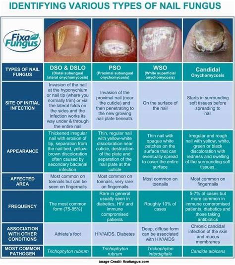 List of 11 Common Nail Problems Everybody Ignores | Toe fungus remedies ...