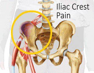 Pain Along Iliac Crest