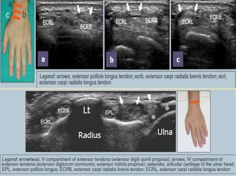 Flexor Tendons Wrist Ultrasound