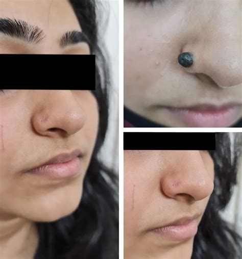 Mole Removal Surgery (Treatment) in Kandivali, Borivali & Malad