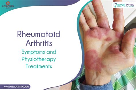 Rheumatoid Arthritis: Symptoms, Diagnosis, & Treatment