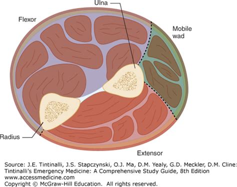 Compartment Syndrome | Anesthesia Key