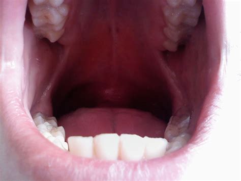 Swollen Epiglottis | Speaks for itself | Matt L | Flickr