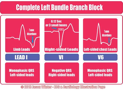 ECG Educator Blog : Bundle Branch Blocks