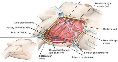 Technique of Radical Mastectomy | Plexus products, Mastectomy, Arteries ...