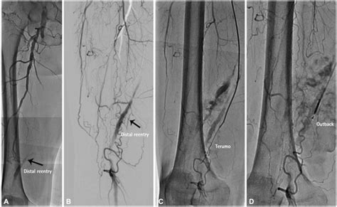 A total occlusion of about 25 cm of the right superficial femoral... | Download Scientific Diagram