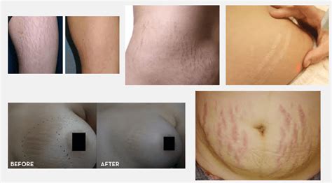 Laser Stretch Mark Removal: The Advanced Way of Removing Stretch Marks