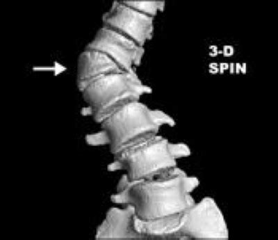 Congenital Scoliosis - OrthoInfo - AAOS