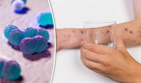 Meningitis symptoms: These are the early signs of the deadly disease ...