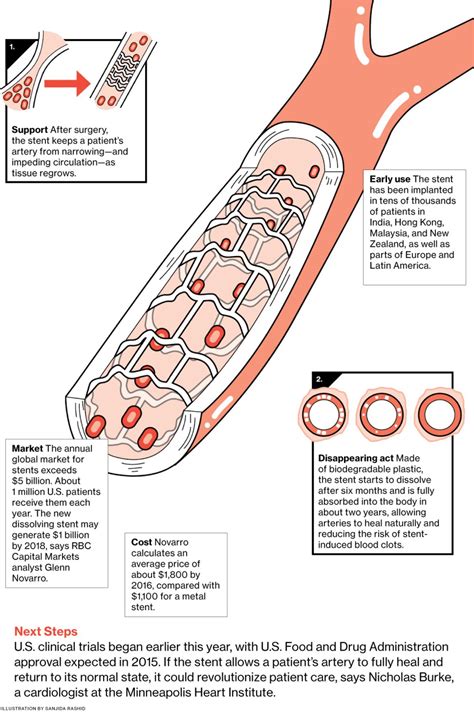 Innovation: Abbott Labs' Dissolving Heart Stent Helps Improve Recovery ...