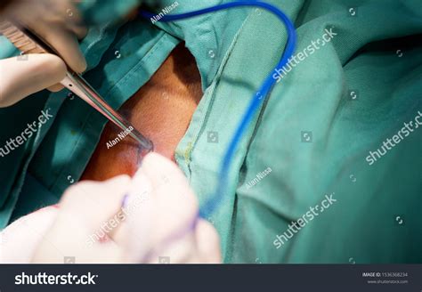 Excision Biopsy Procedure Elliptical Incision Using Stock Photo 1536368234 | Shutterstock