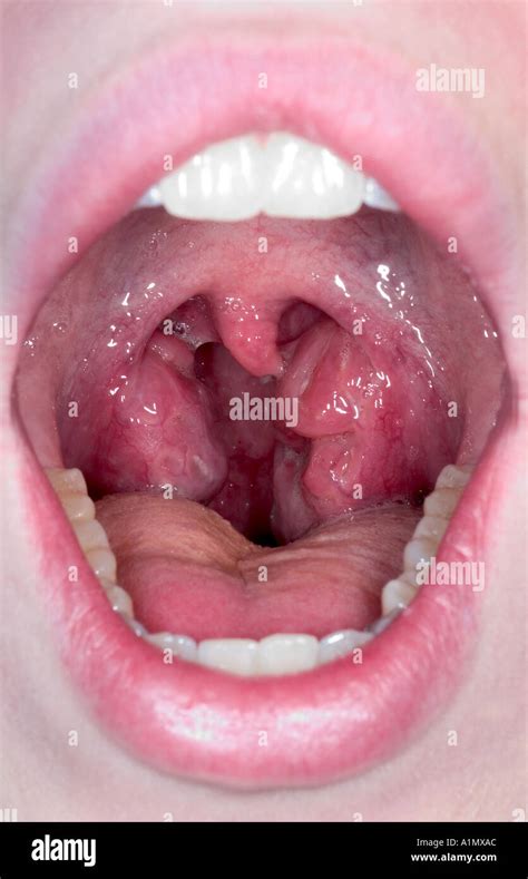 strep throat infection Stock Photo: 3361451 - Alamy