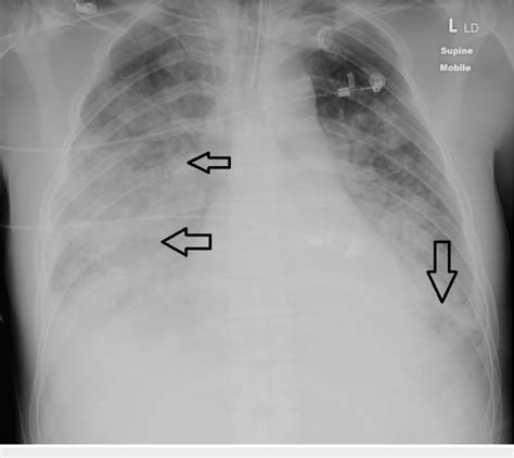 Pulmonary Venous Congestion Chest X Ray | SexiezPicz Web Porn