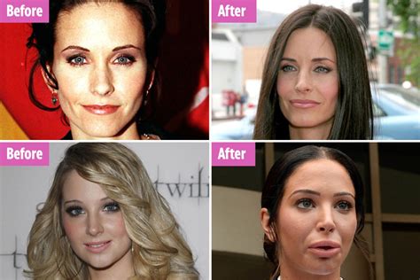 Botox before and after: Which celebrities have had Botox from Courtney ...