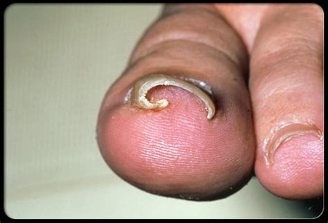 Ingrown Toenails - Top 10 Make Up Cosmetics