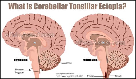 What Is Cerebellar Tonsillar Ectopia Symptoms Causes Diagnosis ...