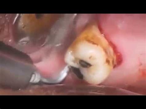 Abscess tooth removal | Tooth Abscess Extraction - YouTube