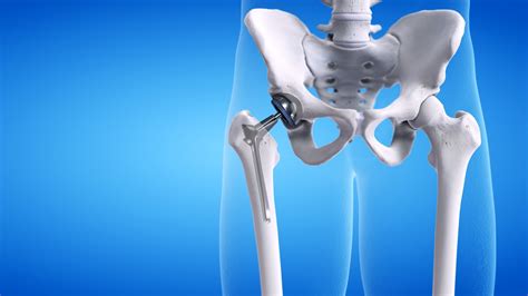 What Your Hip Replacement Implants Are Made Of · Health Vantis