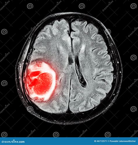 MRI Brain Show Brain Tumor At Right Parietal Lobe Royalty-Free Stock Photo | CartoonDealer.com ...