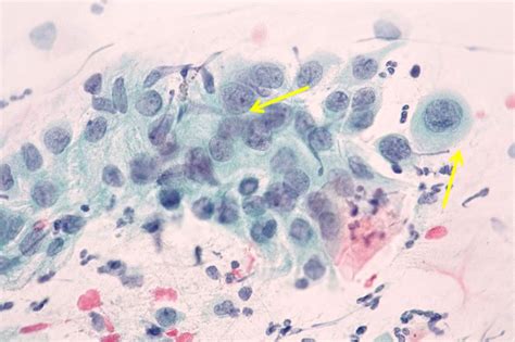 Issues of the Evaluation of Endocervical Cells of the Uterine Cervix on Cytological Smears