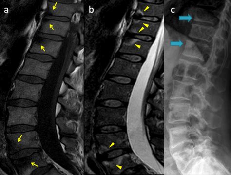 Ankylosing spondylitis. Sagittal dorsolumbar MR in T1 (a) and T2 (b)... | Download Scientific ...