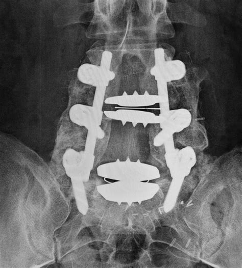 Medical Devices of the Neck and Spine: an imaging guide