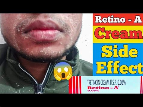 Retino A Side Effects | Tretinoin Side Effects - YouTube