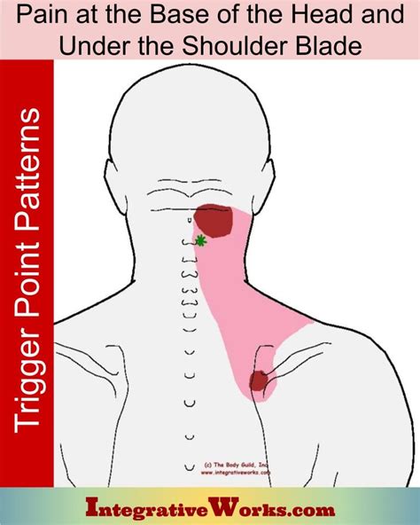 Pain at the Base of the Head and Under Shoulder Blade - Integrative Works | Trigger points, Neck ...