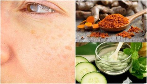 5 Natural Remedies to Prevent Age Spots Home Remedies For Hives, Hives Remedies, Age Spot ...
