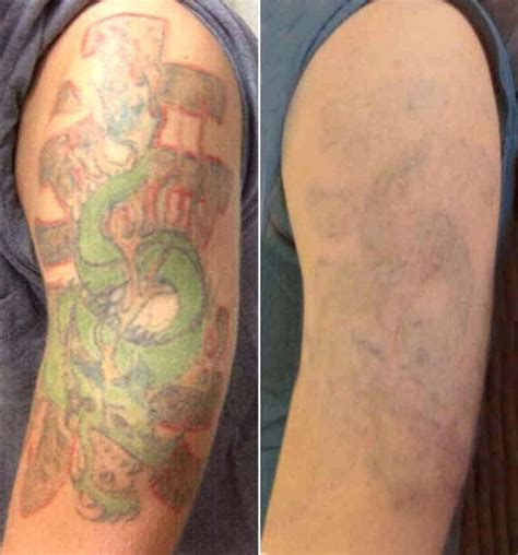 home improvement Cost of tattoo removal - Hairstyle #tattooremovalnatural | Tattoo removal cost ...