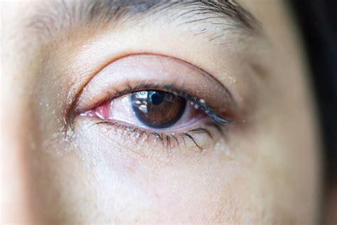 Watery Eyes (Epiphora): Causes & Treatment | MyVision.org