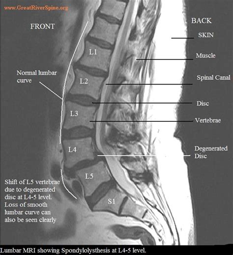 Spondylolisthesis | Texas Spine Center